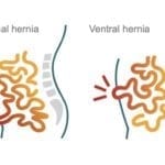 Hernia Repair