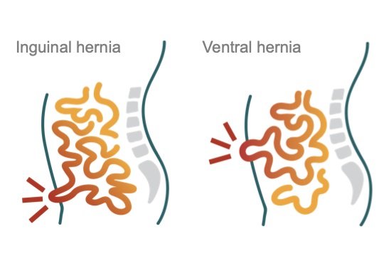 Hernia Repair